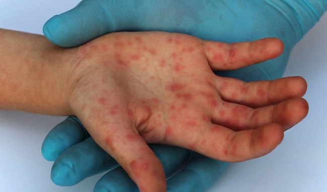 Secretaría de Salud confirma dos casos de viruela símica en Bogotá
